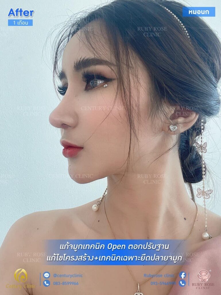 รีวิว แก้จมูก1 #116