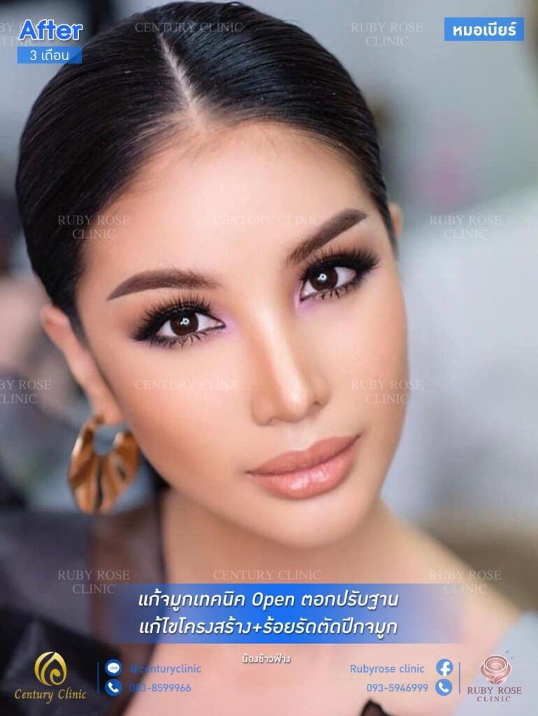รีวิว แก้จมูก1 #123