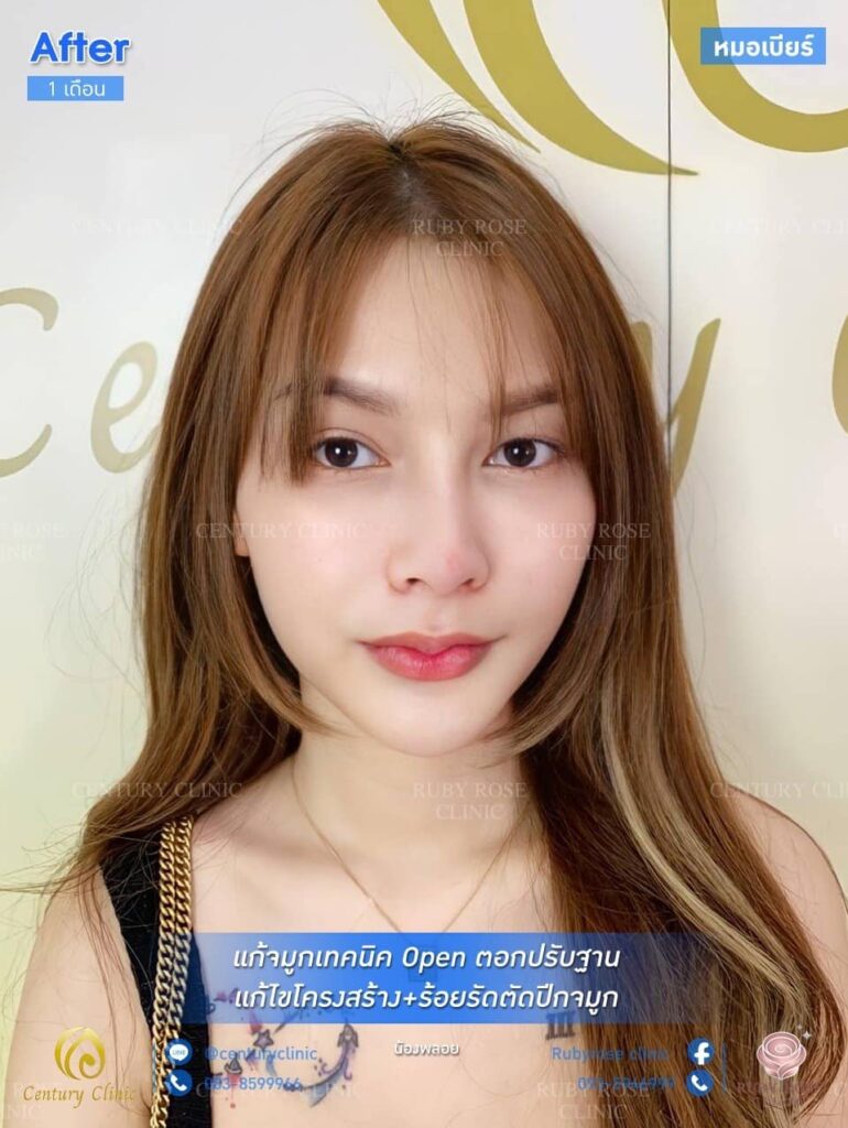 รีวิว แก้จมูก1 #132