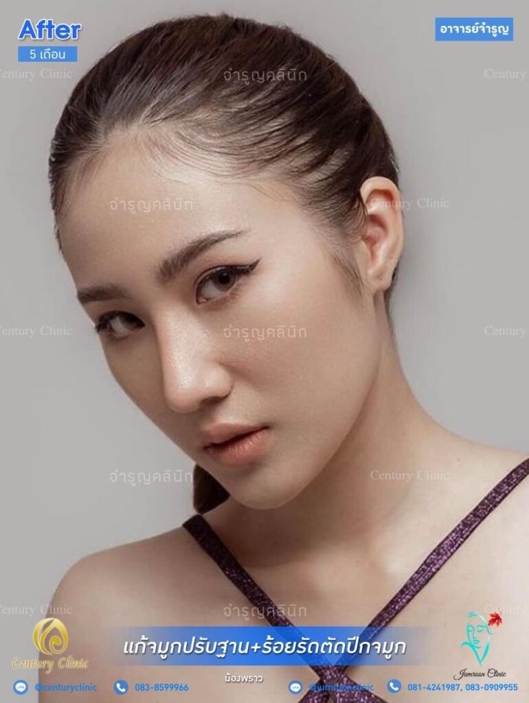 รีวิว แก้จมูก1 #25