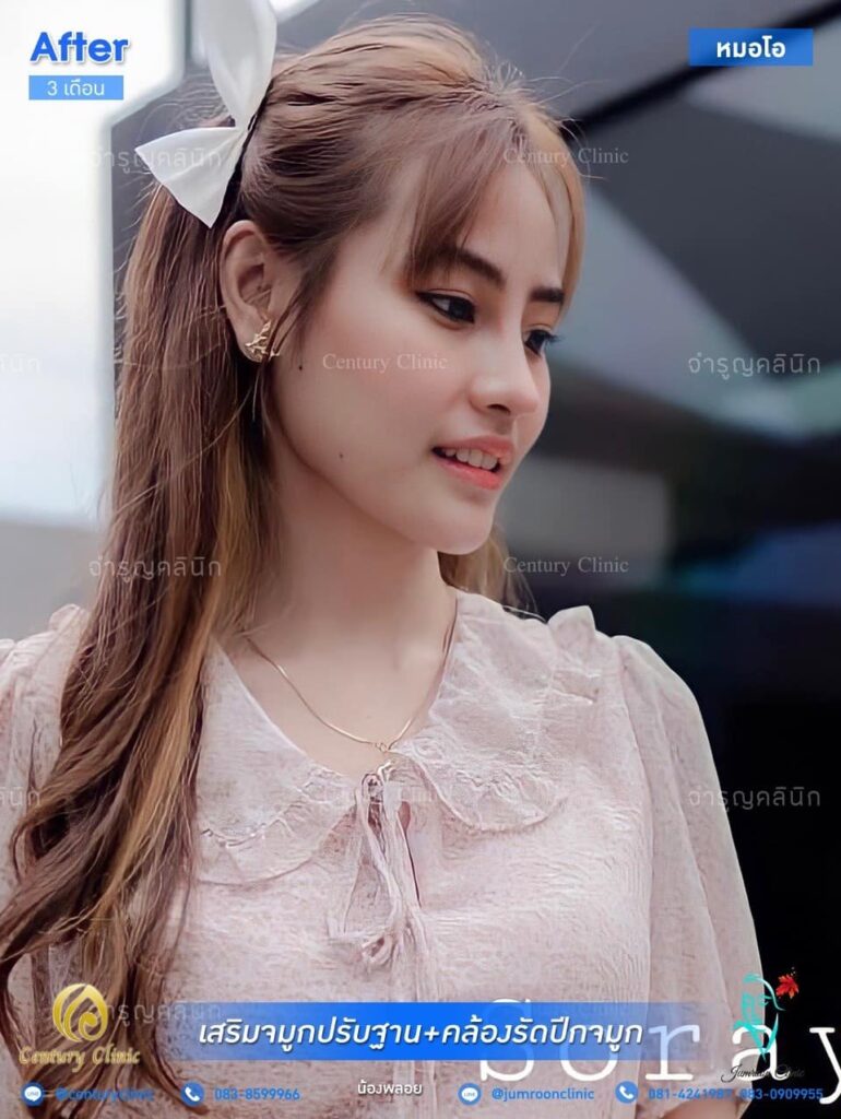 รีวิว แก้จมูก1 #27