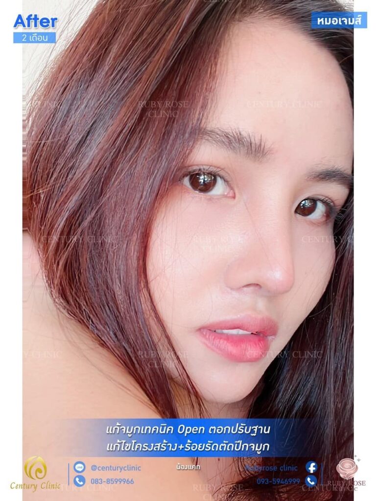 รีวิว เสริมจมูก #28 , Century Clinic Thailand รีวิว แก้จมูก1 #28