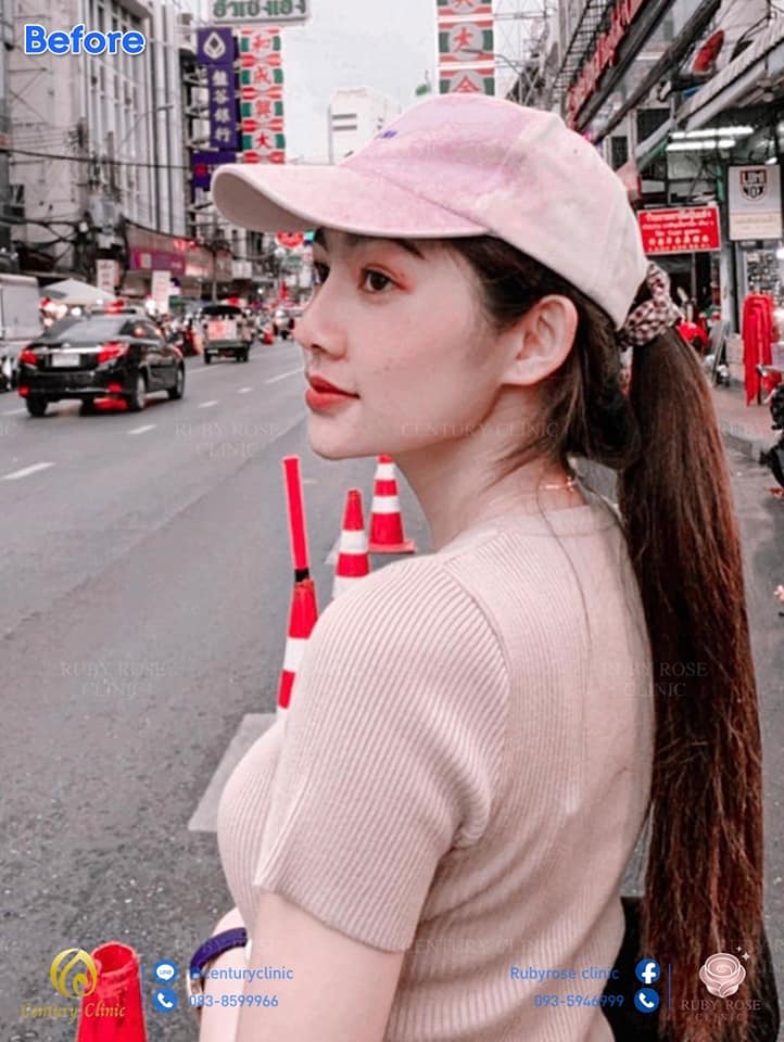 รีวิว แก้จมูก1 #29