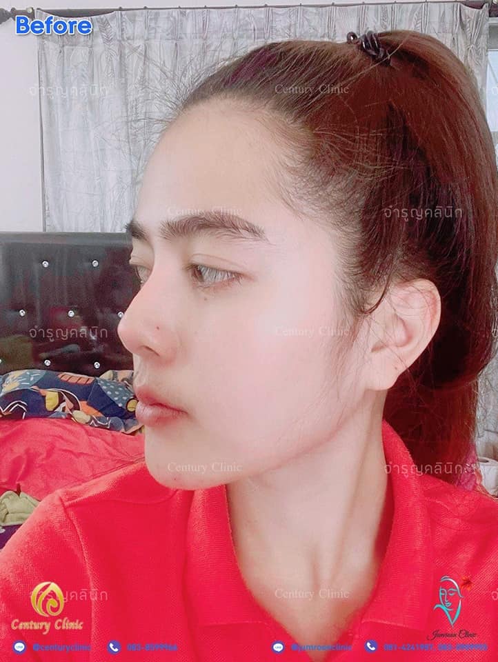 รีวิว แก้จมูก1 #31