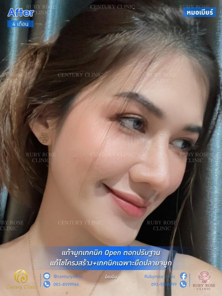 รีวิว แก้จมูก #32 , Century Clinic Thailand รีวิว แก้จมูก1 #32