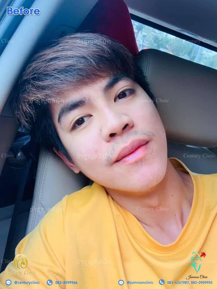 รีวิว แก้จมูก1 #36