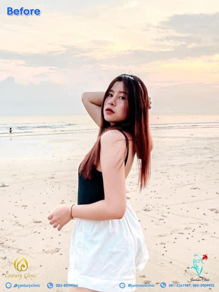 รีวิว แก้จมูก1 #50