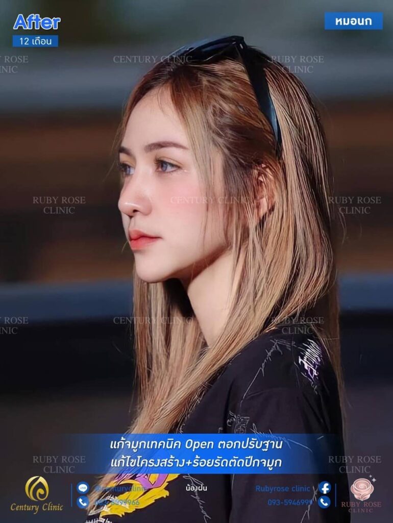 รีวิว แก้จมูก #53 , Century Clinic Thailand รีวิว แก้จมูก1 #53