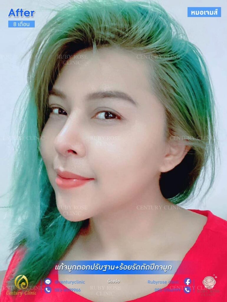 รีวิว แก้จมูก #54 , Century Clinic Thailand รีวิว แก้จมูก1 #54