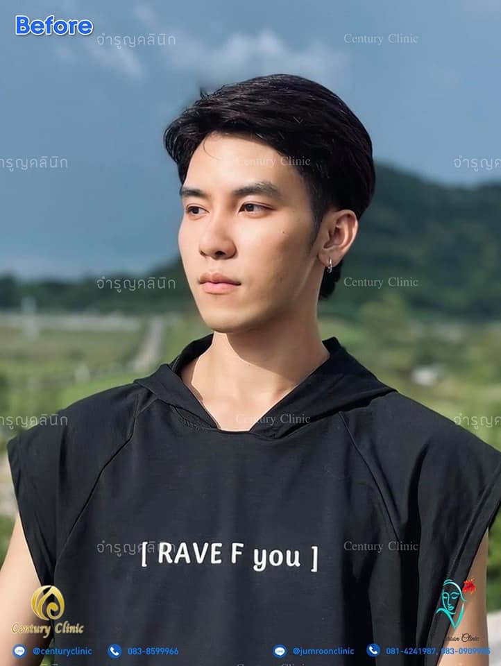รีวิว แก้จมูก1 #58