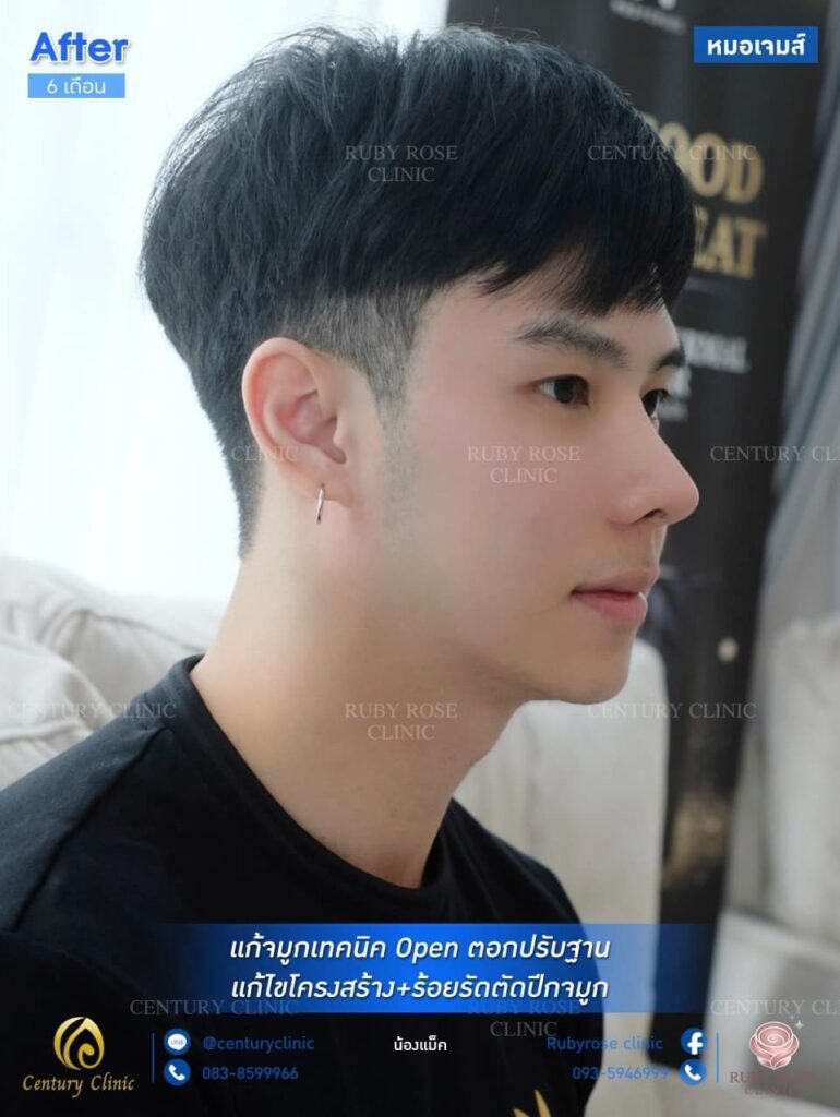 รีวิว แก้จมูก1 #63