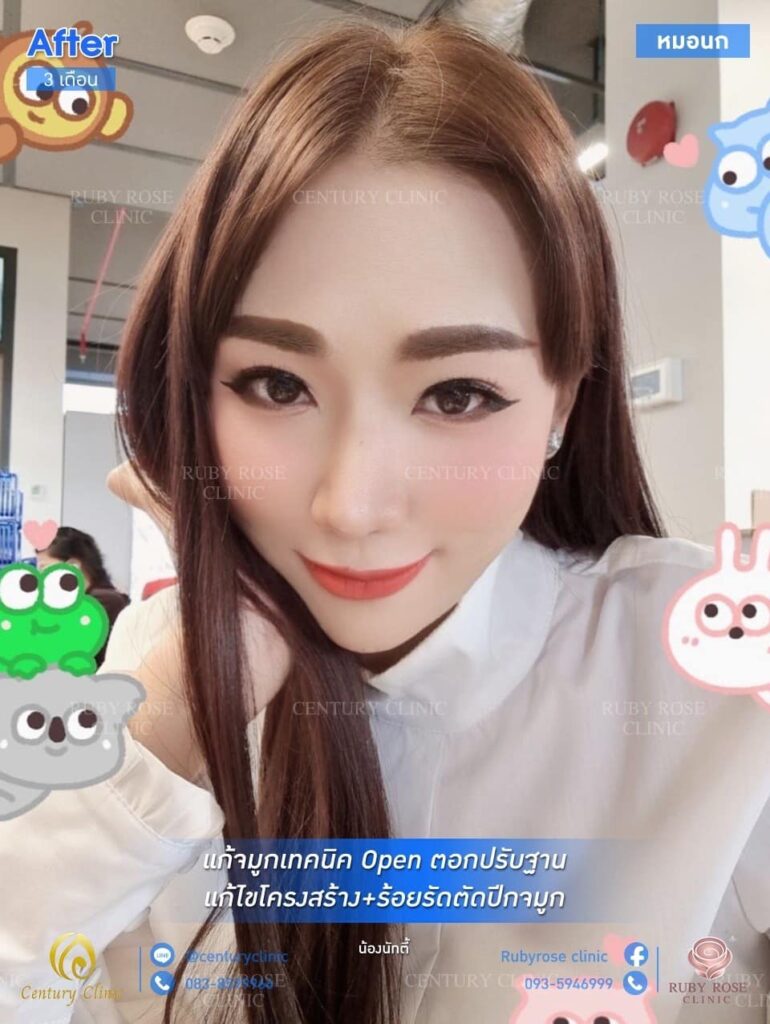 รีวิว แก้จมูก #66 , Century Clinic Thailand รีวิว แก้จมูก1 #66