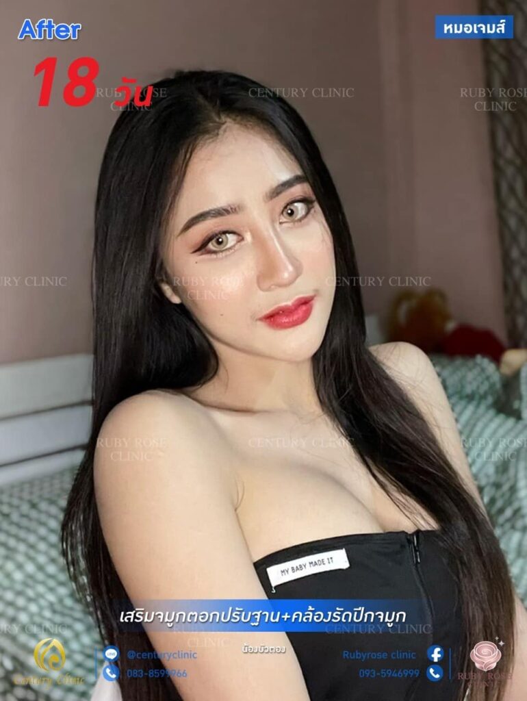 รีวิว แก้จมูก1 #70