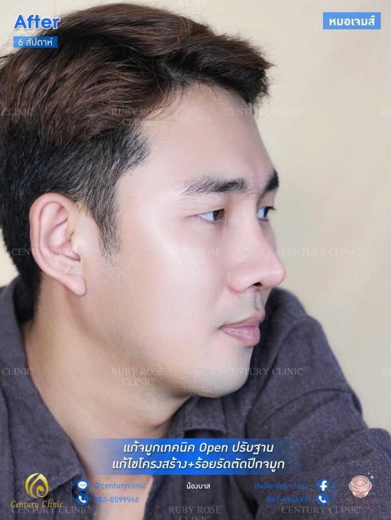 รีวิว แก้จมูก #76 , Century Clinic Thailand รีวิว แก้จมูก1 #76