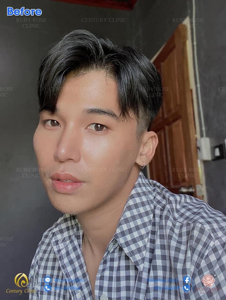รีวิว แก้จมูก1 #84