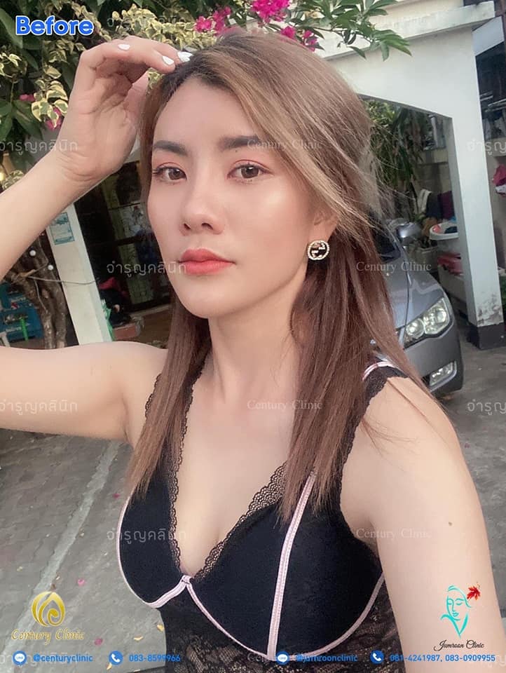 รีวิว แก้จมูก #85 , Century Clinic Thailand รีวิว แก้จมูก1 #86