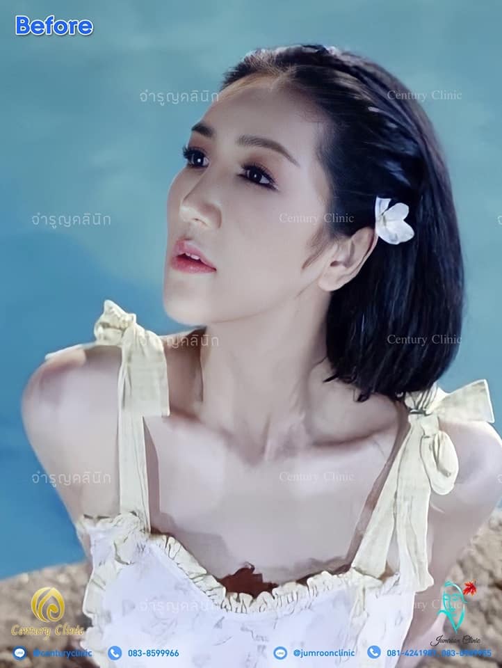 รีวิว แก้จมูก #89 , Century Clinic Thailand รีวิว แก้จมูก1 #90