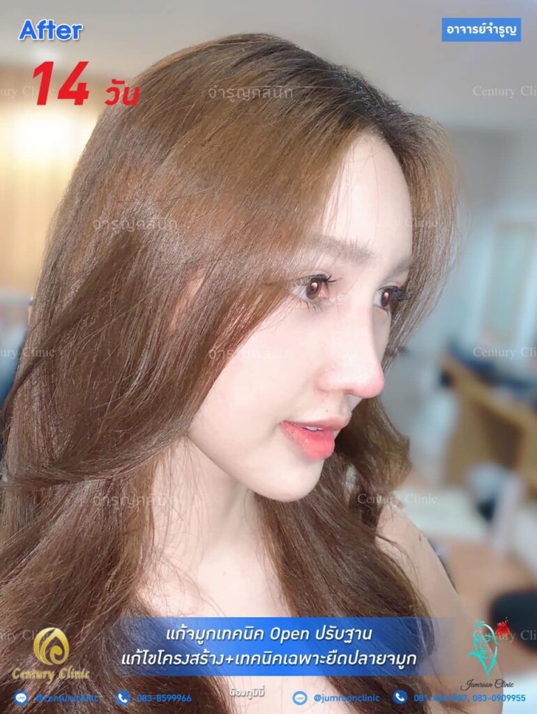 รีวิว แก้จมูก1 #92