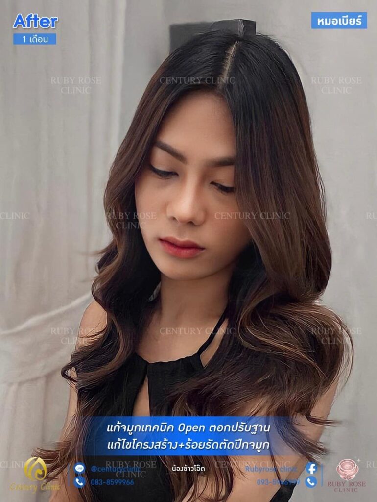 รีวิว แก้จมูก1 #99