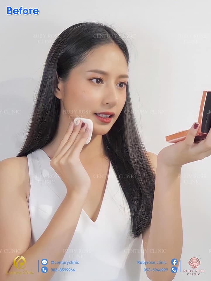 รีวิว แก้จมูก #103 , Century Clinic Thailand รีวิว แก้จมูก2 #103