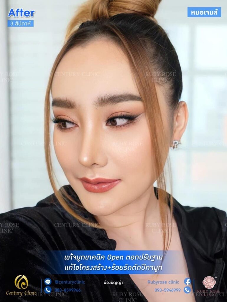 รีวิว แก้จมูก2 #106