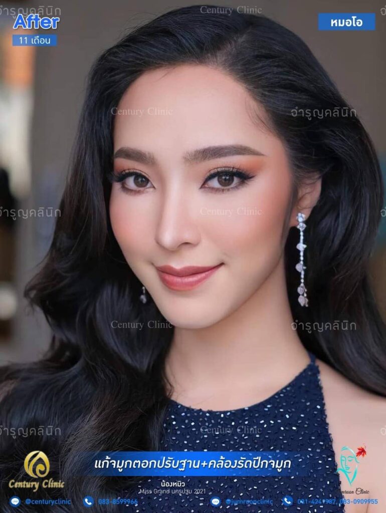 รีวิว แก้จมูก2 #107