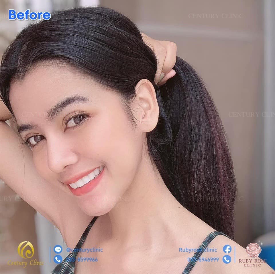 รีวิว แก้จมูก #118 , Century Clinic Thailand รีวิว แก้จมูก2 #118