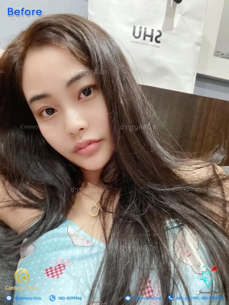 รีวิว แก้จมูก2 #27