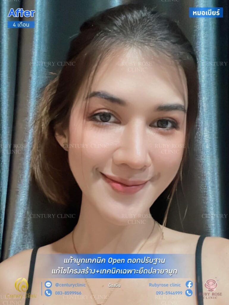 รีวิว แก้จมูก #32 , Century Clinic Thailand รีวิว แก้จมูก2 #32