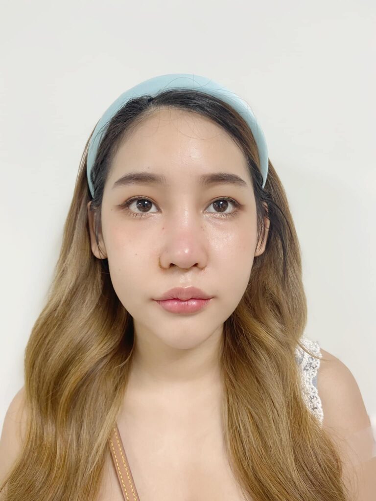 รีวิว แก้จมูก2 #48