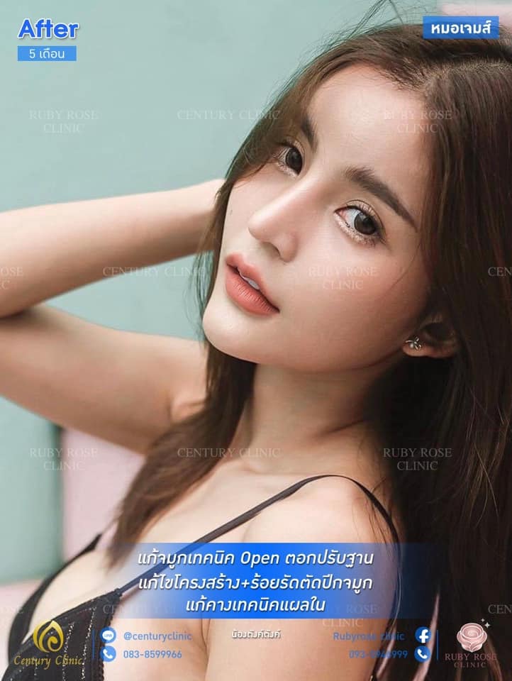 รีวิว แก้จมูก2 #51