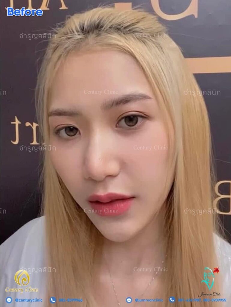 รีวิว แก้จมูก2 #55