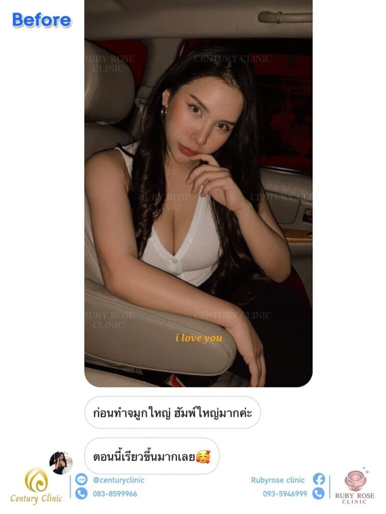รีวิว แก้จมูก2 #59