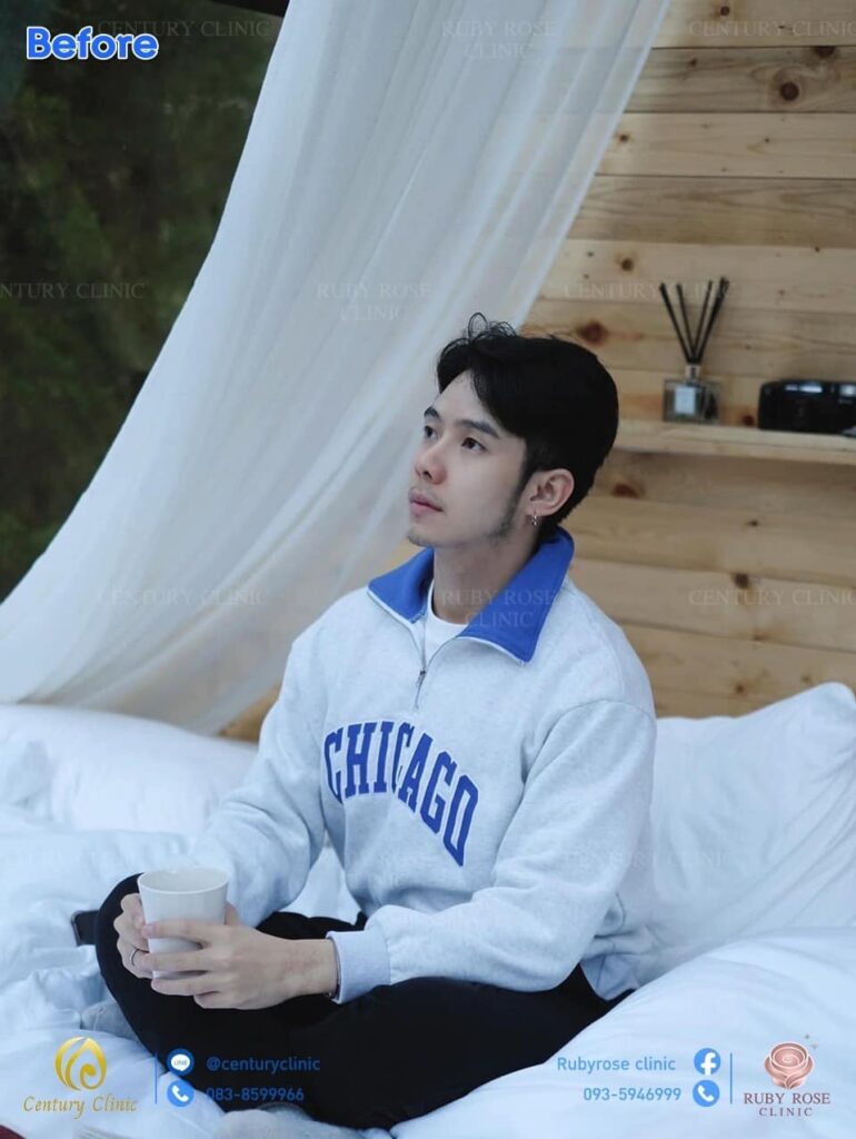 รีวิว แก้จมูก2 #63