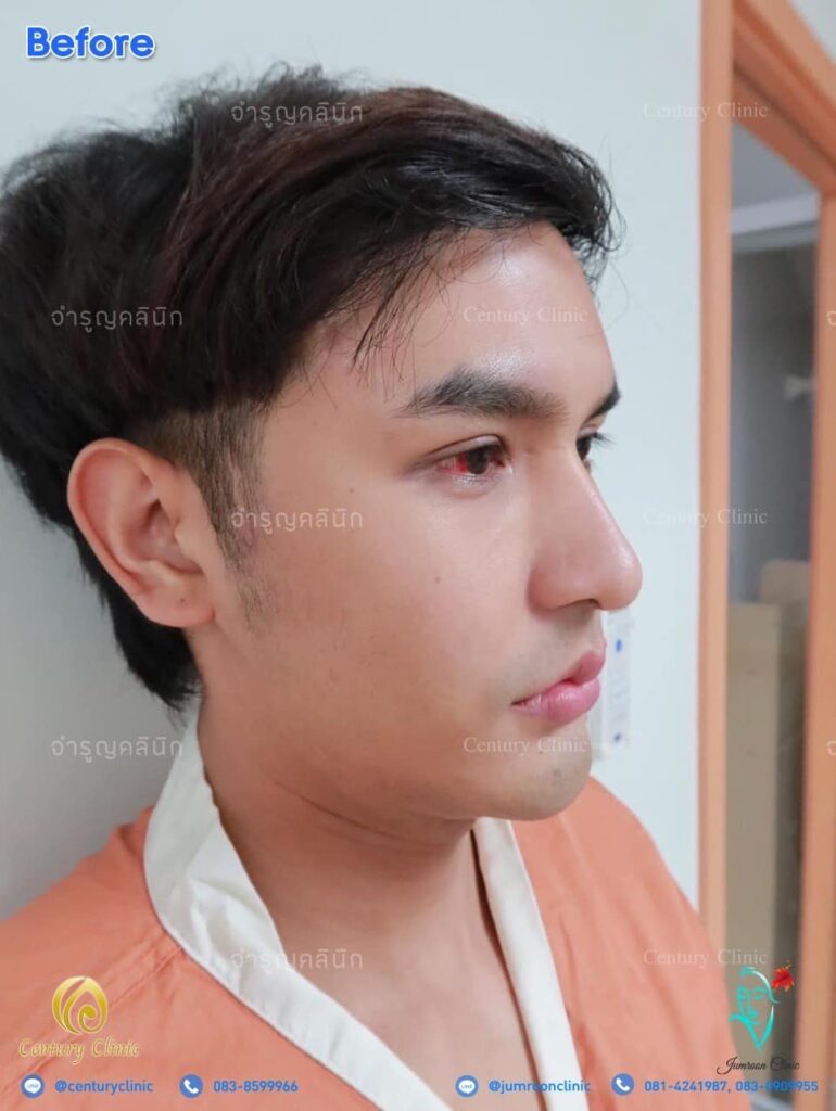 รีวิว แก้จมูก #69 , Century Clinic Thailand รีวิว แก้จมูก2 #69
