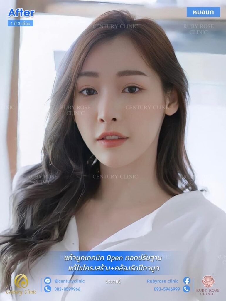รีวิว แก้จมูก #78 , Century Clinic Thailand รีวิว แก้จมูก2 #78