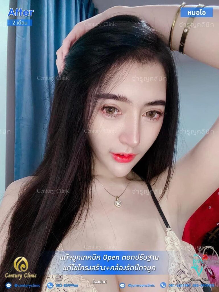 รีวิว แก้จมูก2 #87