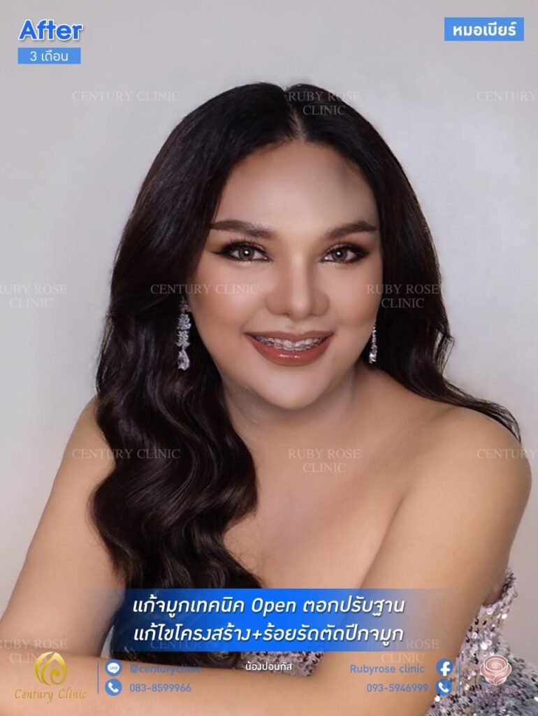 รีวิว แก้จมูก #88 , Century Clinic Thailand รีวิว แก้จมูก2 #89