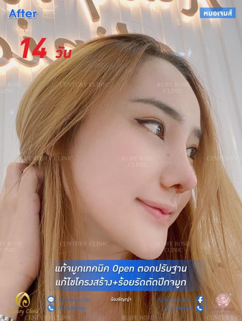รีวิว แก้จมูก #91 , Century Clinic Thailand รีวิว แก้จมูก2 #91