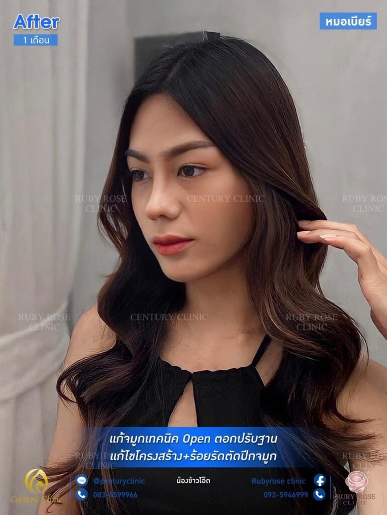 รีวิว แก้จมูก2 #99