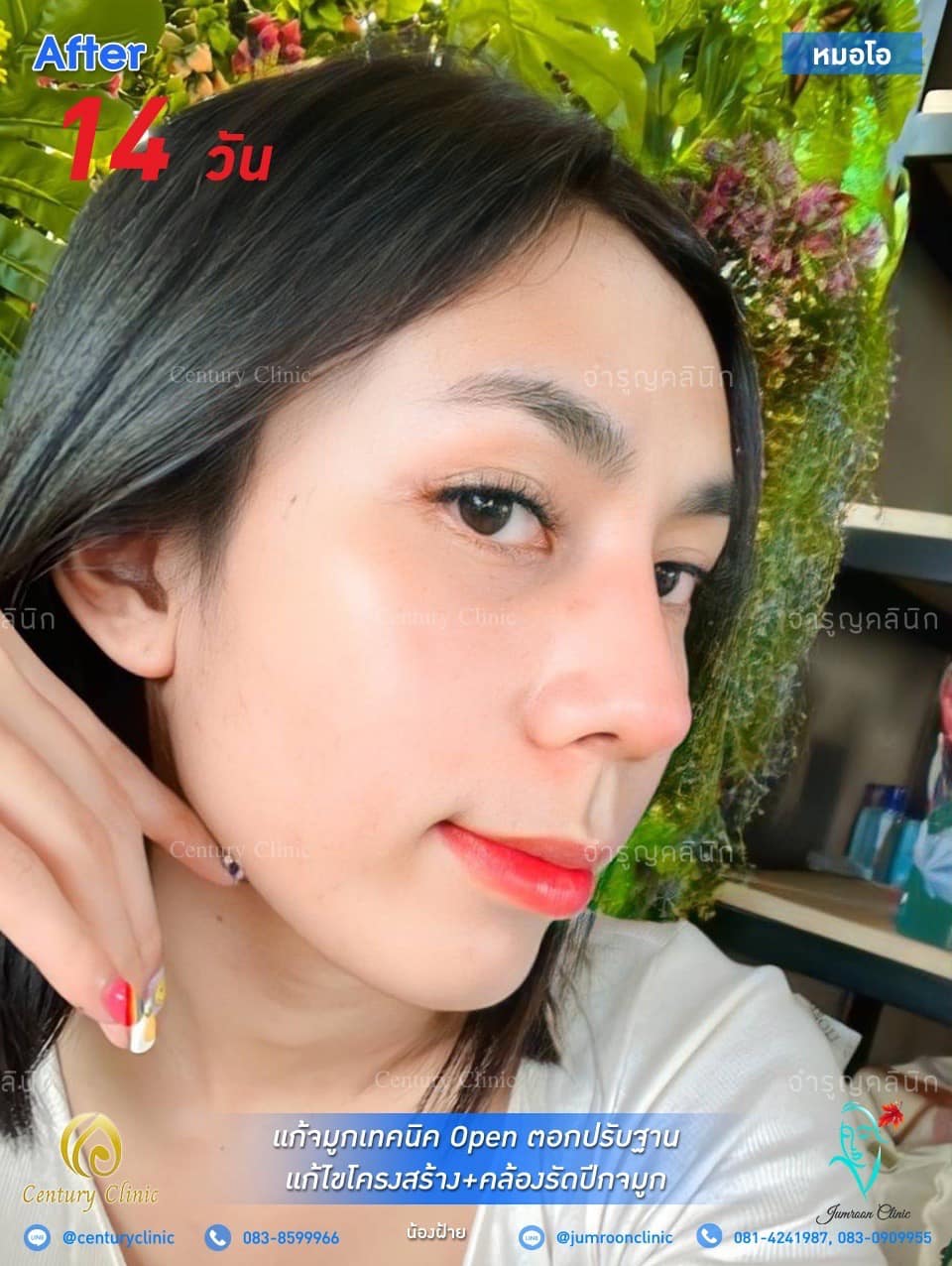 รีวิว แก้จมูก #23 , Century Clinic Thailand รีวิว แก้จมูก23-CenturyClinic