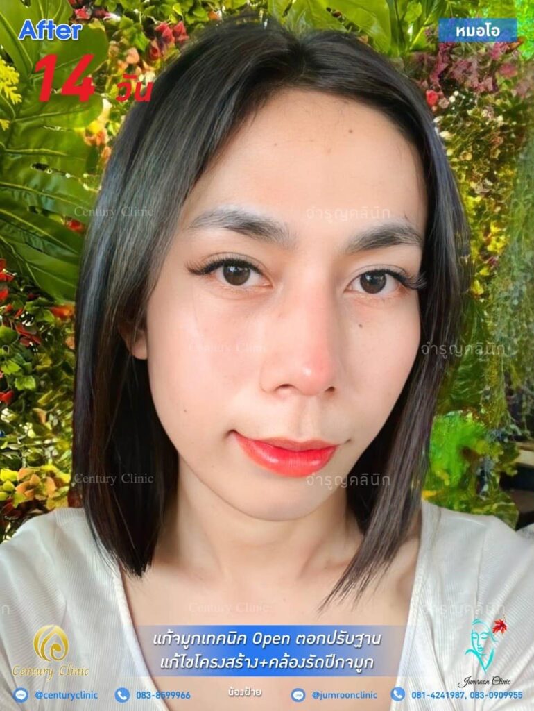 รีวิว แก้จมูก #23 , Century Clinic Thailand รีวิว แก้จมูก23.1-CenturyClinic