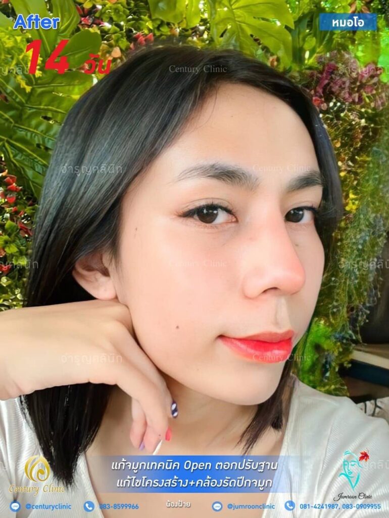 รีวิว แก้จมูก #23 , Century Clinic Thailand รีวิว แก้จมูก23.2-CenturyClinic