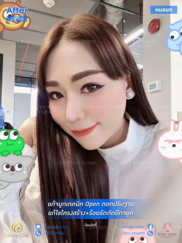 รีวิว แก้จมูก #66 , Century Clinic Thailand รีวิว แก้จมูก2#66