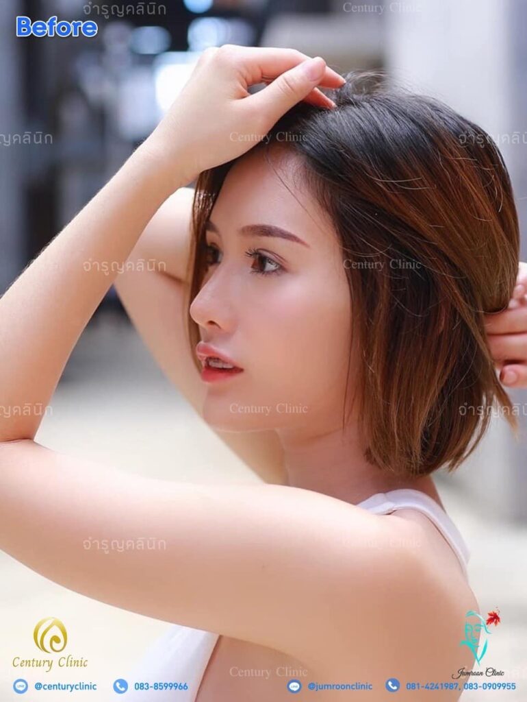 รีวิว แก้จมูก #105 , Century Clinic Thailand รีวิว แก้จมูก3 #105