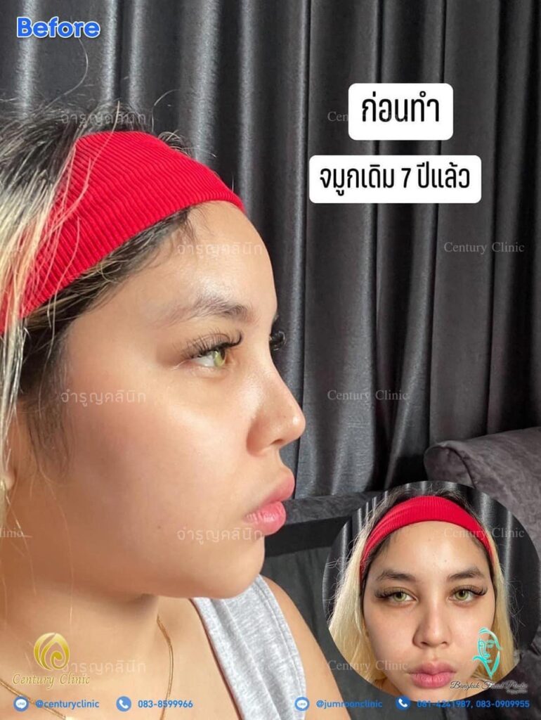 รีวิว แก้จมูก #110 , Century Clinic Thailand รีวิว แก้จมูก3 #110
