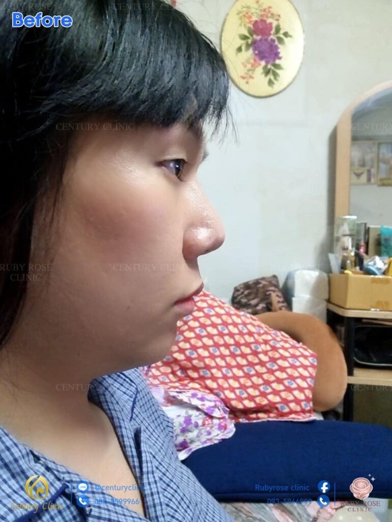 รีวิว แก้จมูก #66 , Century Clinic Thailand Century Clinic Thailand
