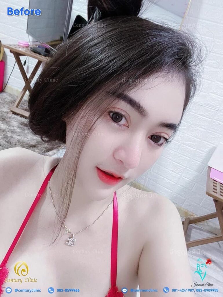 รีวิว แก้จมูก3 #87