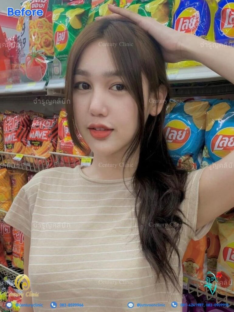 รีวิว แก้จมูก3 #92