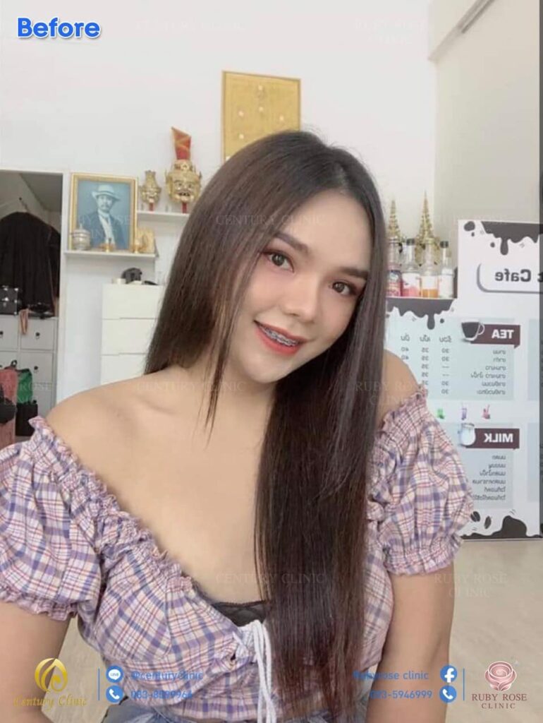 รีวิว แก้จมูก #88 , Century Clinic Thailand รีวิว แก้จมูก3#89